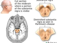 Parkinson:   qual è la causa&nbsp;?