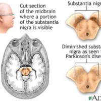 Parkinson:   qual è la causa&nbsp;?